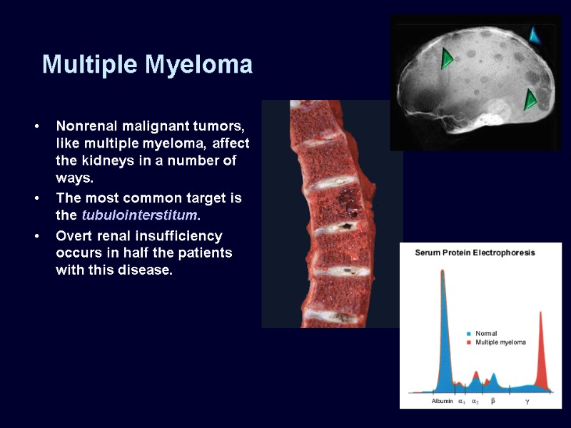 Multiple Myeloma Nonrenal malignant tumors, like multiple myeloma, affect the kidneys in a number
